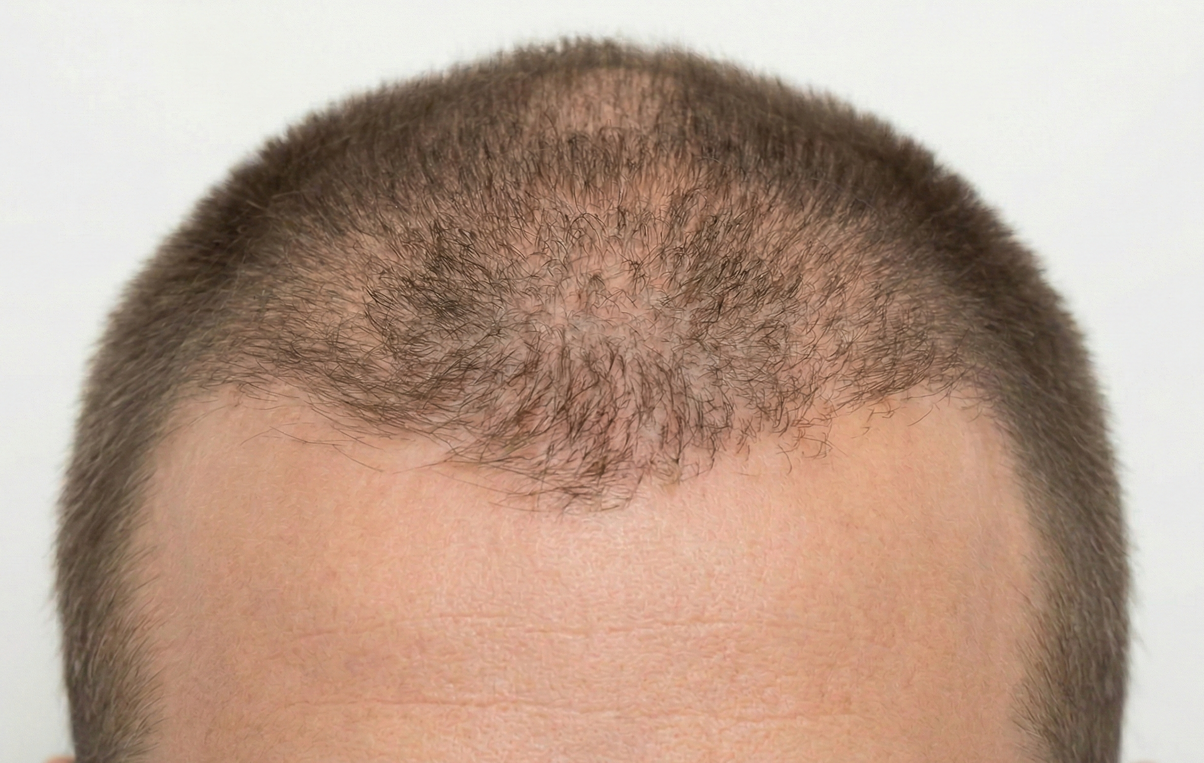 Depois de 4 meses de tratamento para queda de cabelo com mesoterapia e LED